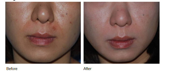 Beauty Secret for Lip Filling & Nasolabial Folds From Singderm Fillers