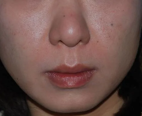 Hyaluronic Acid Lip Filler for Aesthetic