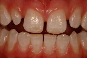 Cosmetic Dentistry Porcelain Dental Veneers with Treatments Crowns / Bridges