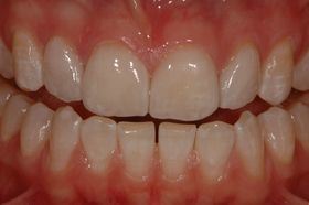 Cosmetic Dentistry Porcelain Dental Veneers with Treatments Crowns / Bridges
