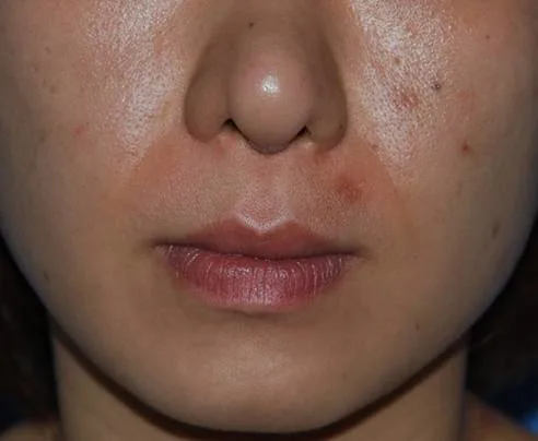 Hyaluronic Acid Lip Filler for Aesthetic